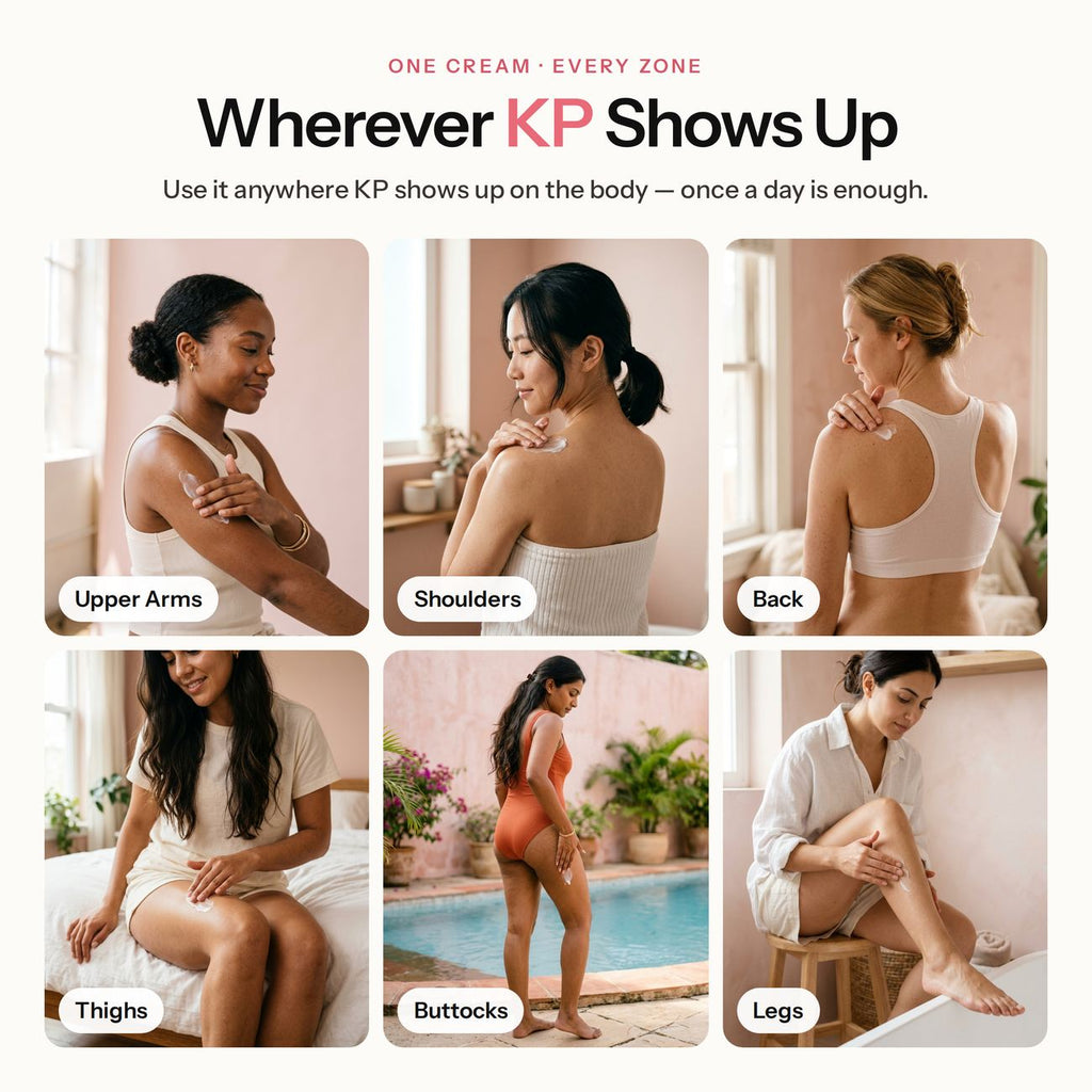 Keratosis pilaris on upper arms, shoulders, back, thighs, buttocks and legs: one KP body cream for every zone