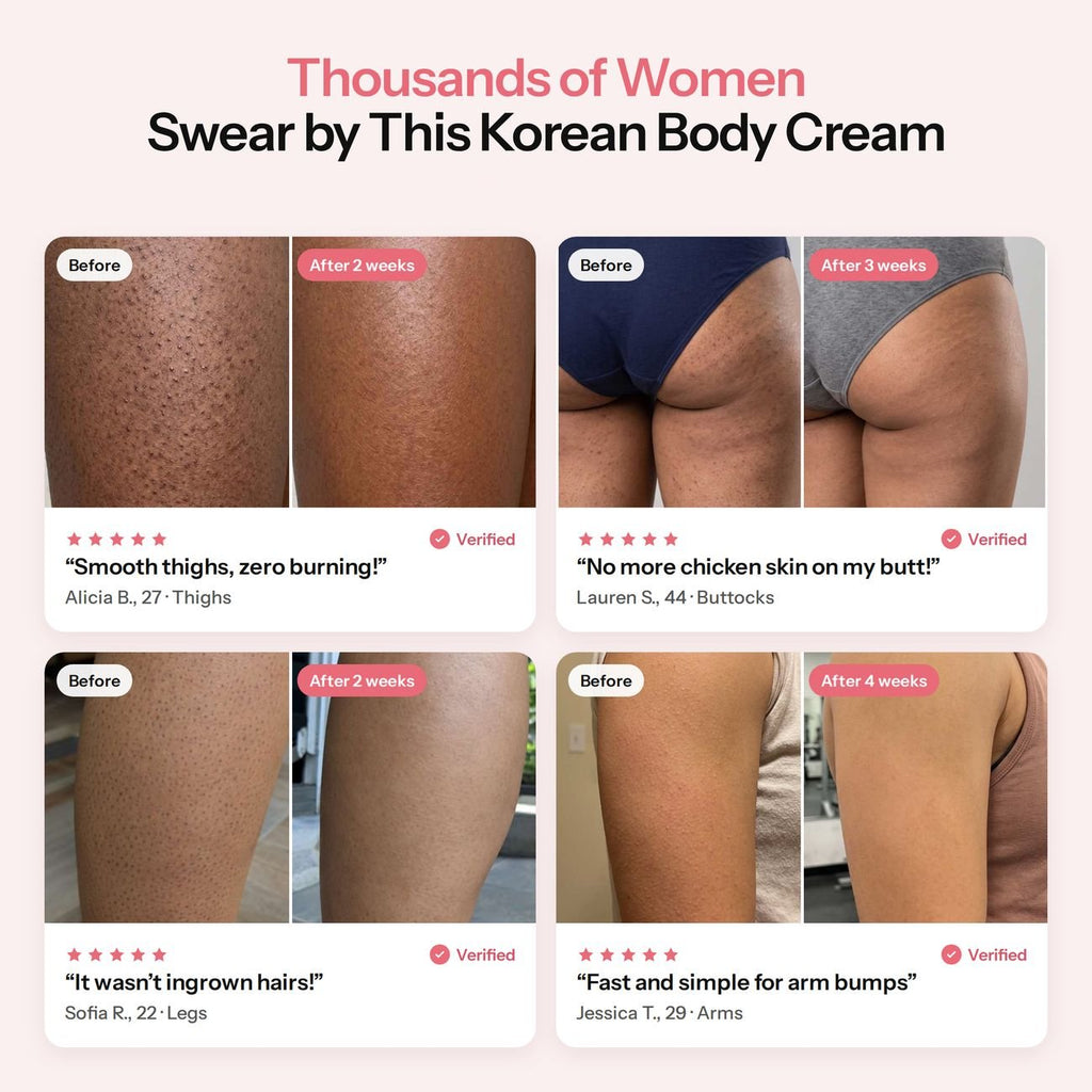 Real customer keratosis pilaris before and after results on thighs, buttocks, legs and arms with MIMOYA