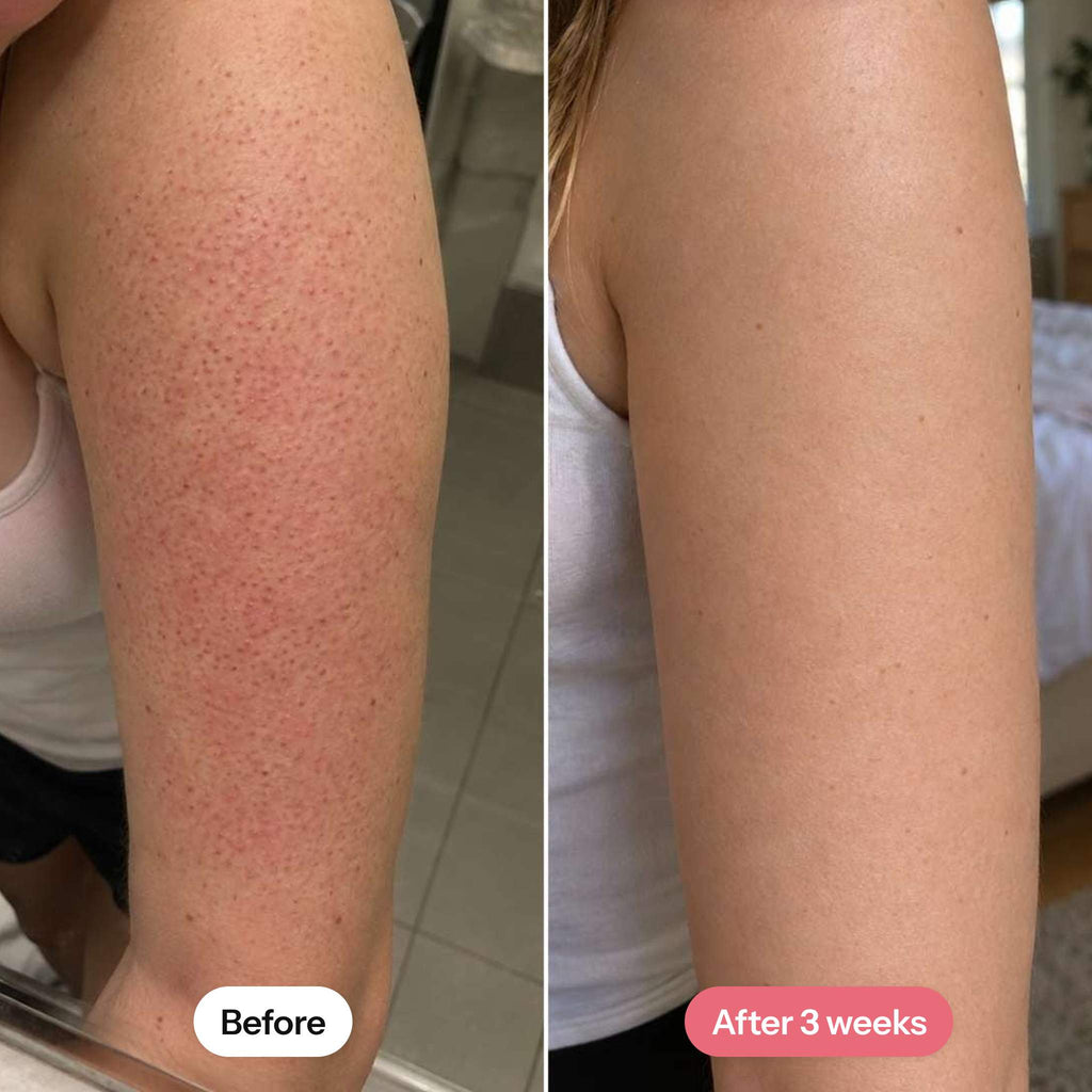 Keratosis pilaris on the upper arm before and after 3 weeks of MIMOYA KP Smooth Cream