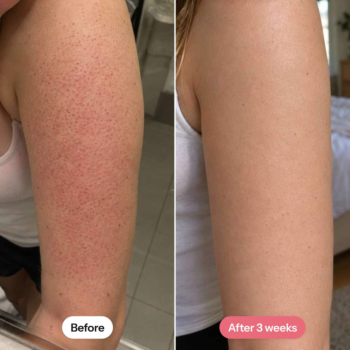 Keratosis pilaris on the upper arm before and after 3 weeks of MIMOYA KP Smooth Cream