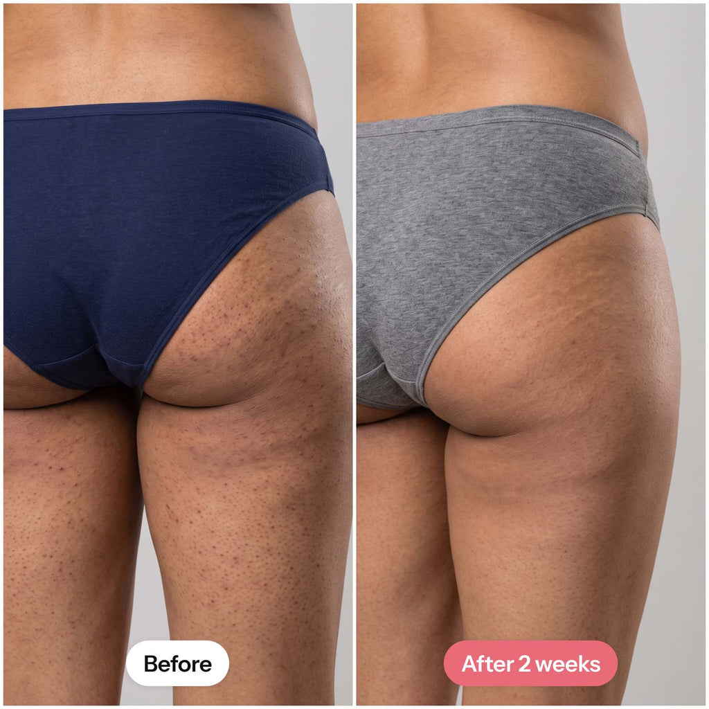 Keratosis pilaris on the buttocks and thighs before and after 2 weeks of MIMOYA KP Smooth Cream